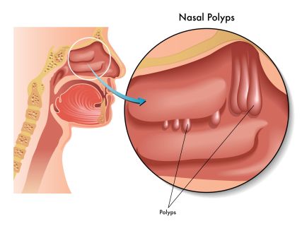 nasal-polyps-treatment